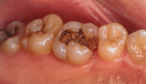 臼歯(奥歯)の虫歯