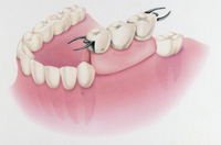 可撤性部分床義歯