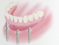 インプラント支持の取り外し式総入れ歯